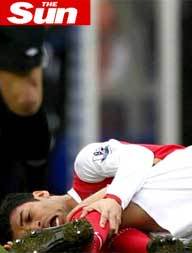 Futebol: Foto de Fratura de Eduardo da Silva do Arsenal Impressiona