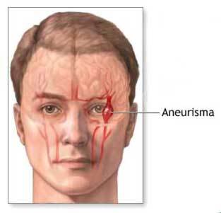 Aneurisma Cerebral