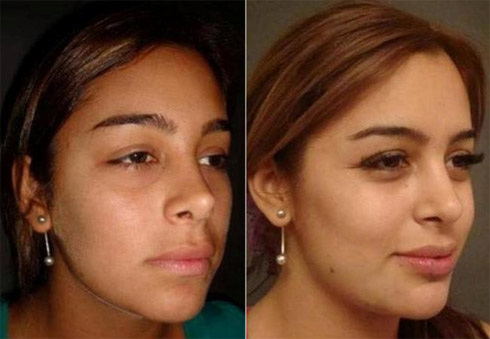 Larissa Riquelme e as Fotos das Plásticas Antes da Fama