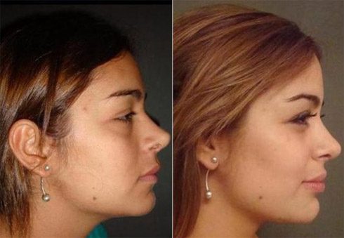 Larissa Riquelme e as Fotos das Plásticas Antes da Fama