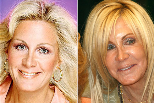 Celebridades Transformadas Pelo Excesso de Cirugias Plásticas