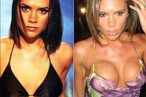 Celebridades Transformadas Pelo Excesso de Cirugias Plásticas
