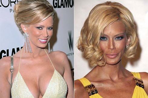 Celebridades Transformadas Pelo Excesso de Cirugias Plásticas