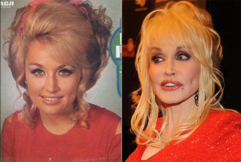 Celebridades Transformadas Pelo Excesso de Cirugias Plásticas
