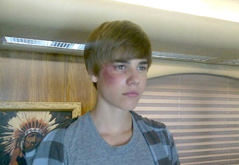 Foto de Justin Bieber de Olho Roxo em CSI