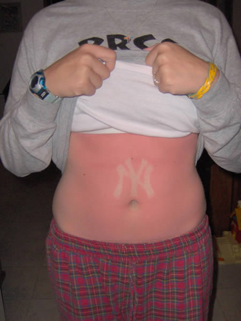 Tatuagem solar: uma moda perigosa