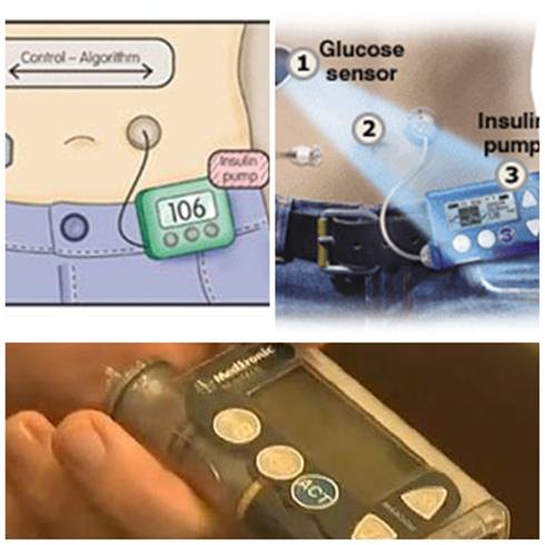 Pâncreas artificial promete controlar insulina e tratar diabetes